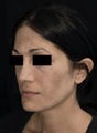 Laser Skin Resurfacing