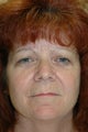 Laser skin resurfacing, eyelid surgery, lip augmentation
