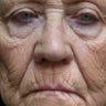 Laser Resurfacing