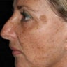 Laser Resurfacing