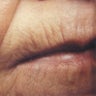 Laser Resurfacing