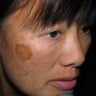 Laser Resurfacing