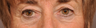 Laser Skin Resurfacing