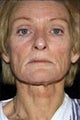 Laser Resurfacing