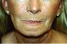 Laser Skin Resurfacing with Dr. Clevens