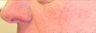 KTP Laser