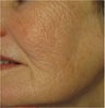 Evolastin- Non Surgical Lift