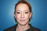 BBL and MLP Laser treatment for hyperpigmentation