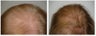 Low Lever Laser Light Therapy
