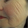 Evolastin- Non Surgical Lift