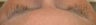 Latisse treatments for eyelashes