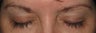 Latisse before and after