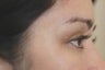 Latisse for eyelashes