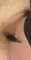 Lashes treated with Lumigan/Latisse