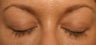LATISSE