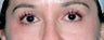 Latisse for Eyelashes