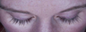 Latisse