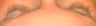 Latisse treatments for eyelashes