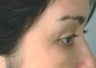Latisse for eyelashes