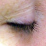 Dr. Lorrie Klein's eyelashes before and after Latisse