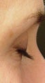 Lashes treated with Lumigan/Latisse
