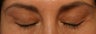LATISSE