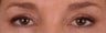 Eyelash Growth from Latisse