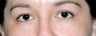 Latisse for Eyelashes
