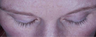 Latisse