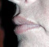 Lip Filler Type Augmentation