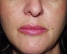 Lip Augmentation: fat injections to lips