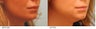 Lip Reduction
