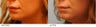 Lip Reduction