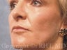 Permanent lip enlargement and Laser Treatment