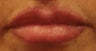 Lip Augmentation