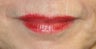 lip filler