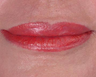 Lip Augmentation