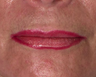 Lip Augmentation