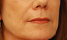 Injectable Filler