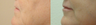 Fillers to the lips