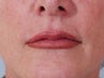 Lip Augmentation
