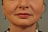 Lip Injection