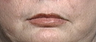 Lip Augmentation
