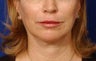 Before and After Lip Augmentation