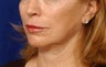 Beforeand After Lip Augmentation