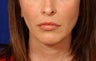 Before and After Lip Augmentation