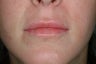 Lip enhancement