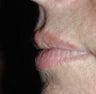 Lip Filler Type Augmentation