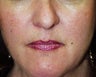Lip Augmentation: fat injections to lips