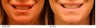 Lip Reduction